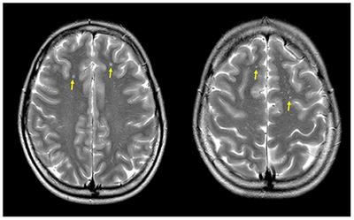 Can aura migraine be elicited by isolated pulmonary arteriovenous fistula?—A case report